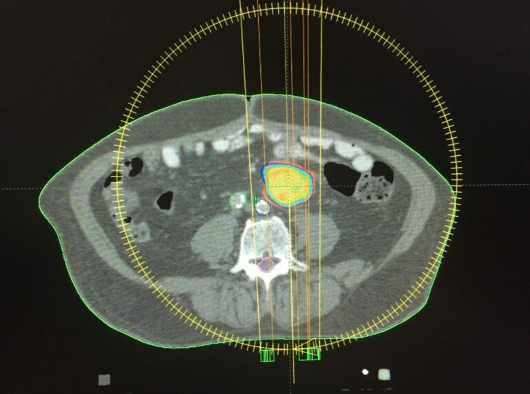 Radiocirugía intracraneal