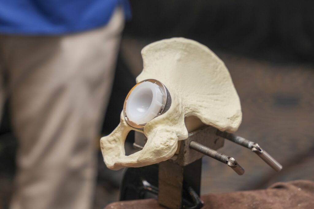 FOTO Sistema de copa acetabular G7 en pelvis