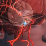 cerebro vascular