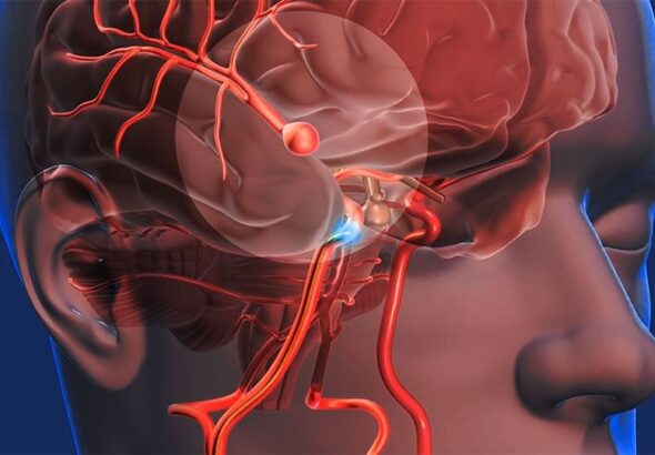 cerebro vascular