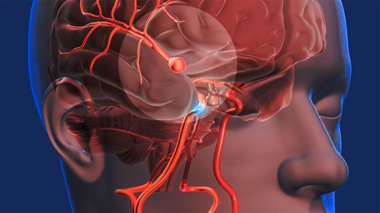 cerebro vascular