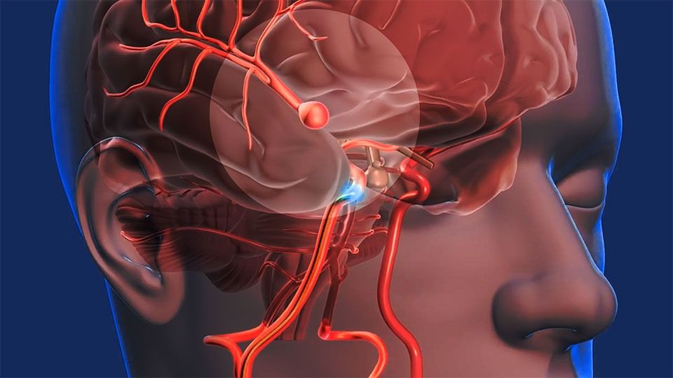 cerebro vascular