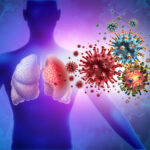 Triple Virus Lung Infection