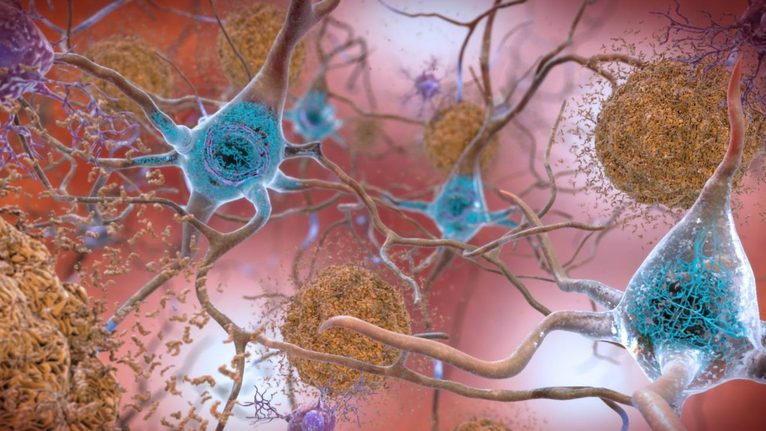 El-alzheimer-una-enfermedad-infecciosa